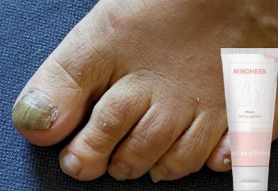 Mikoherb cremă este un produs creat pentru a trata micoza unghiei, ajutând la eliminarea infecțiilor fungice și la restaurarea sănătății unghiilor, način primjene, gdje kupiti, Hrvatska.